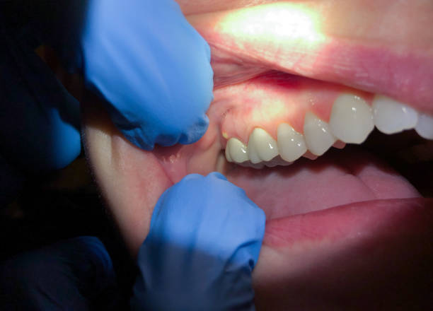 Best Broken or Cracked Tooth Emergency Dentist in Clarkston Heights Vineland, WA